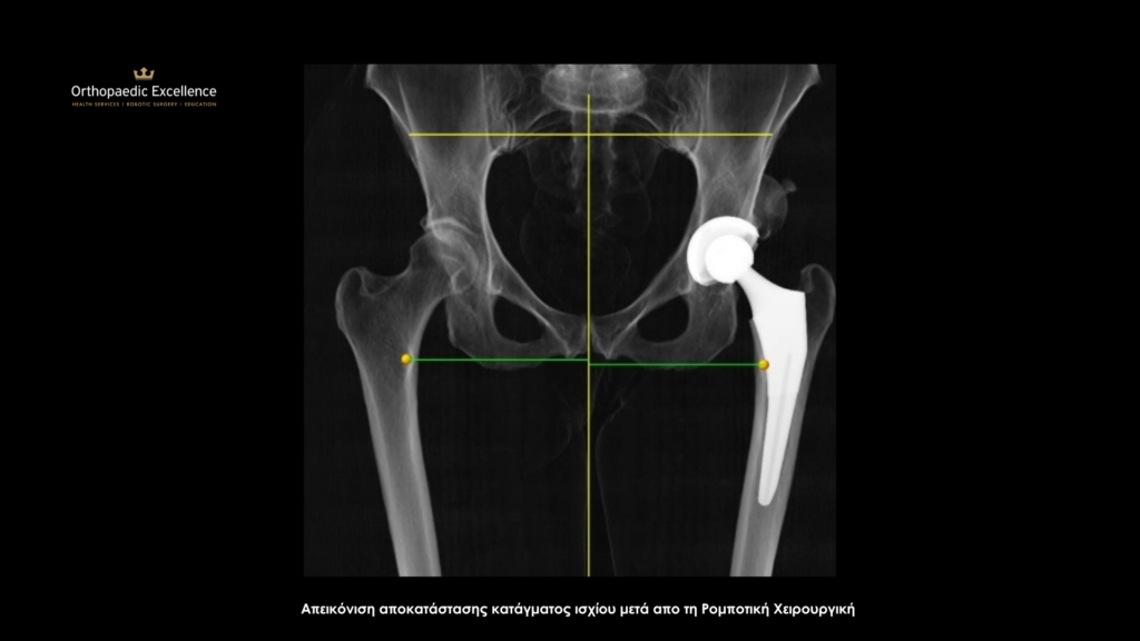 κάταγμα ισχίου